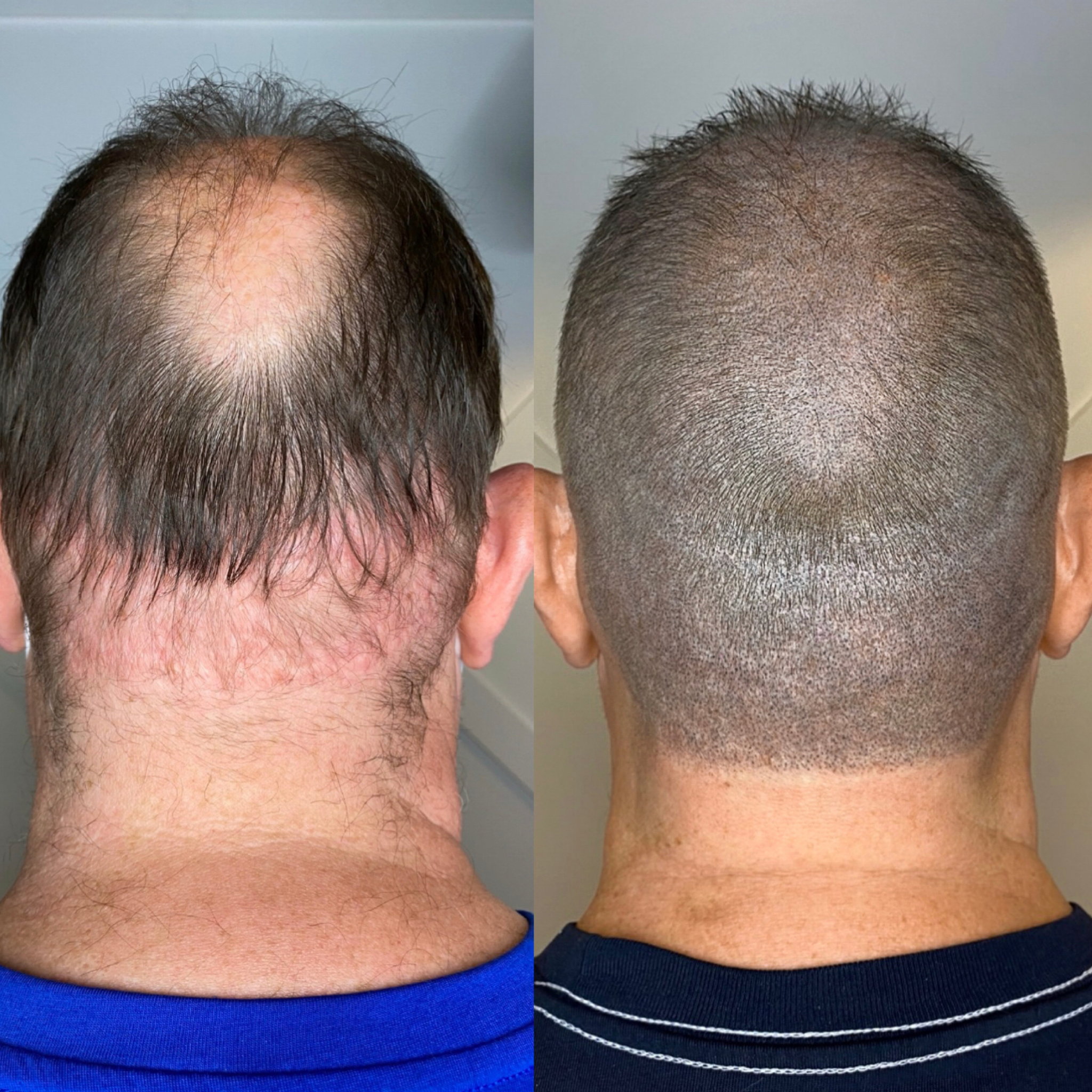 Hair Transplant SMP Camouflage