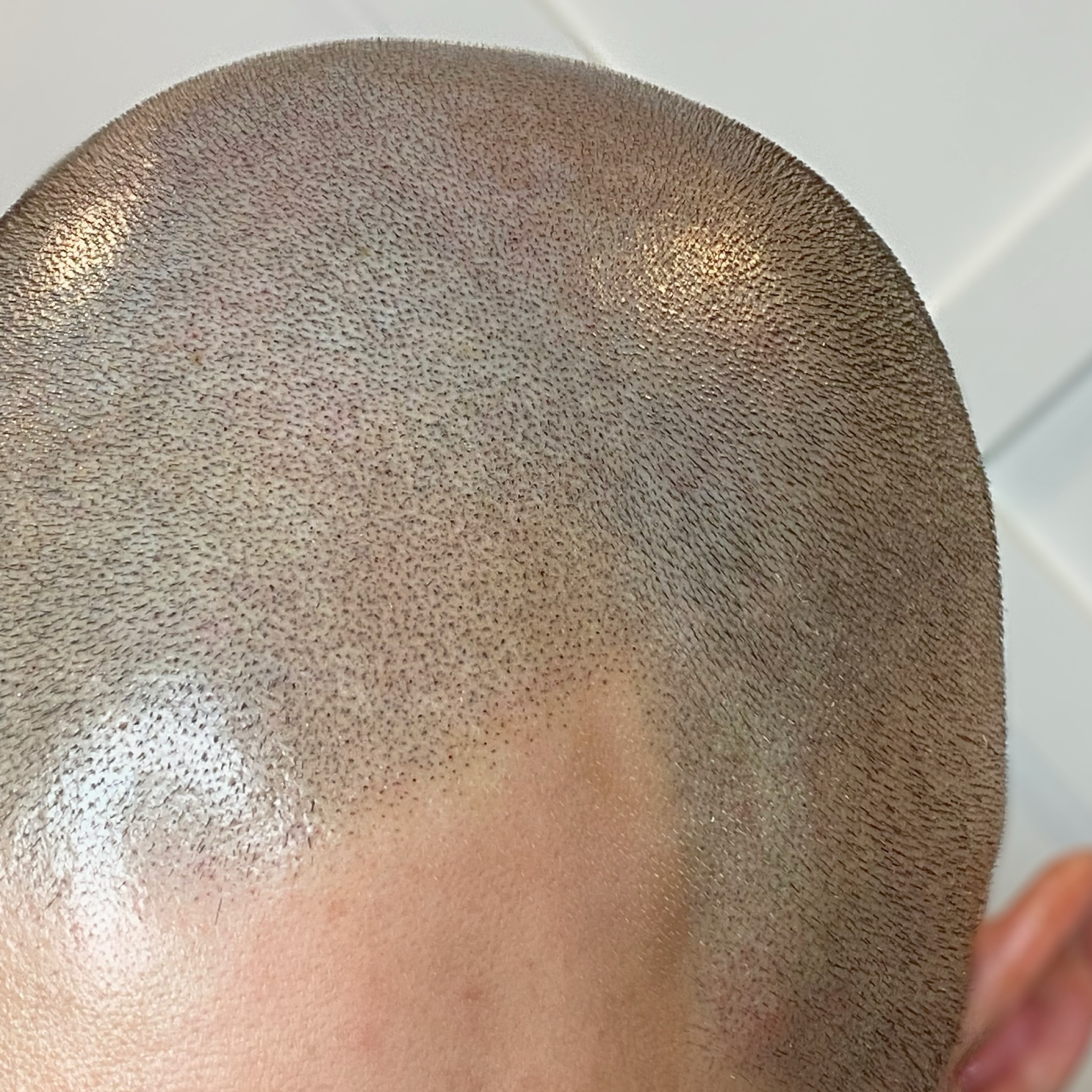 SMP AFTERCARE AND PREPARATION FOR YOUR SESSION