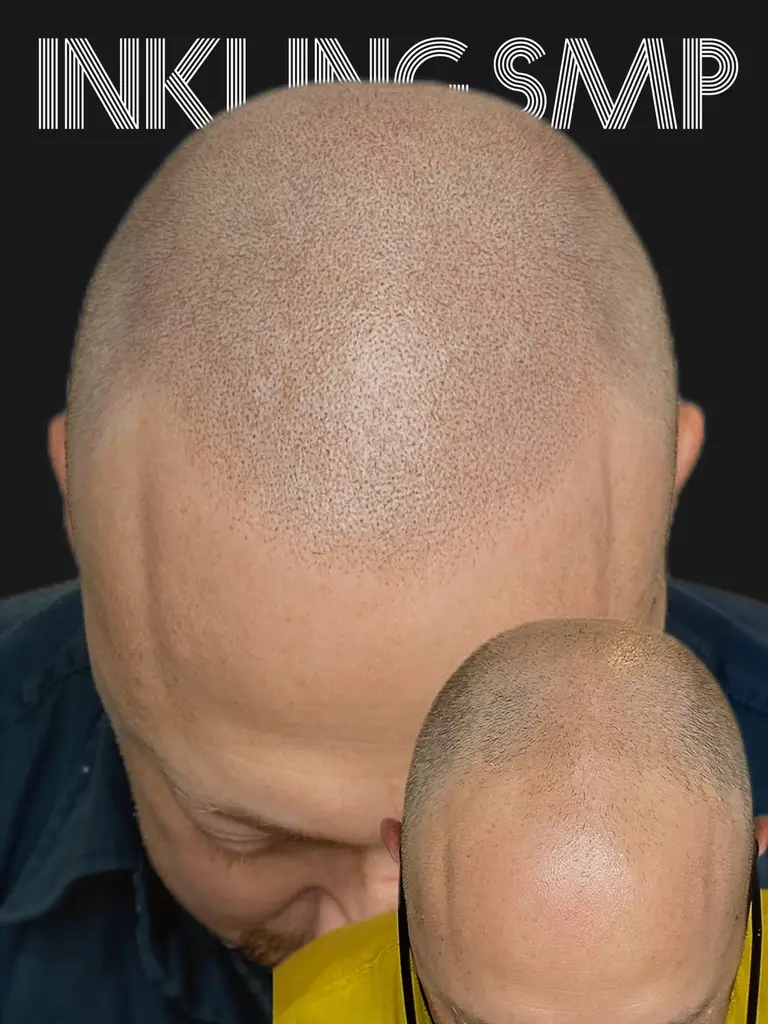 SMP Hairline Restoration with scalp micropigmentation
